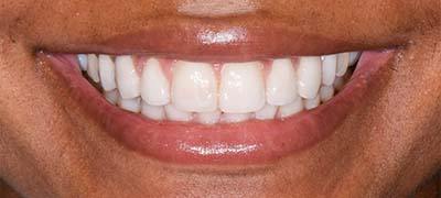 Closeup of perfectly aligned smile after clear braces orthodontics