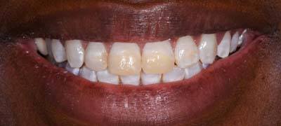 Closeup of smile with large gap between front teeth before clear braces orthodontics