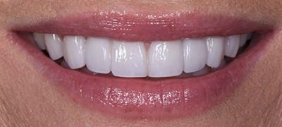 closeup of perfect smile after cosmetic dentistry
