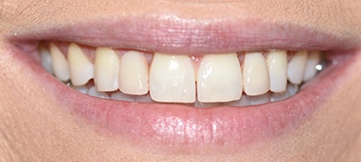 closeup of imperfect smile before cosmetic dentistry