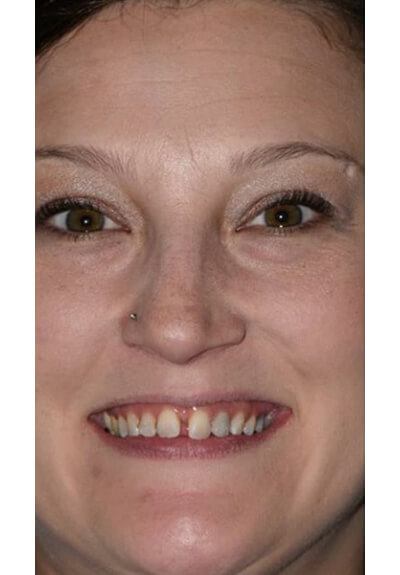Woman with large gap between front teeth before clear braces orthodontics