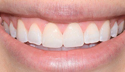 Closeup of white teeth and beautiful smile after cosmetic dentistry