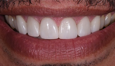Healthy beautiful and aligned teeth after cosmetic dentistry and clear braces