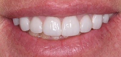 Brilliant white front teeth after teeth whitening