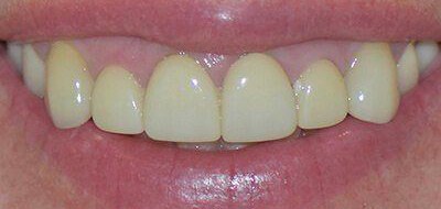 Yellow front teeth before teeth whitening