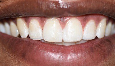 Perfectly aligned smile after cosmetic dentistry