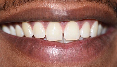 Unevenly spaced teeth before cosmetic dentistry