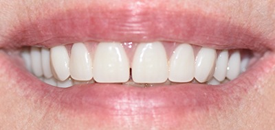 Gorgeous and healthy smile after cosmetic dentistry