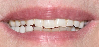 Worn and damaged teeth before cosmetic dentistry