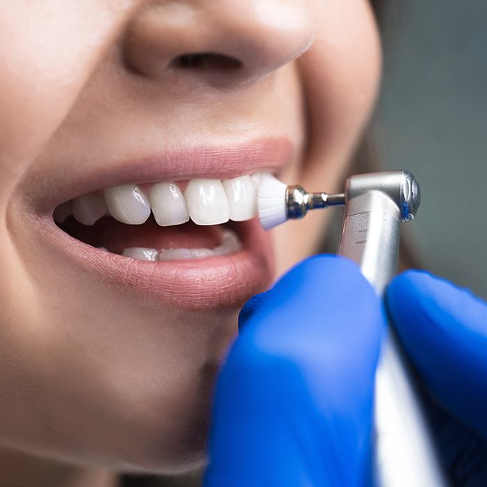 A closeup of a patient receiving a teeth cleaning