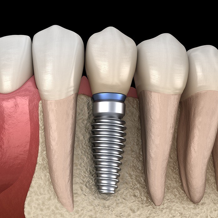 Animated dental implant placement in jawbone
