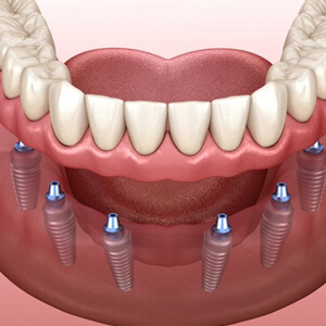 Illustration of implant dentures