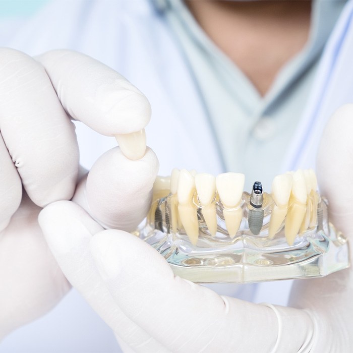 Closeup of a dentist’s gloved hands holding the crown of a model dental implant