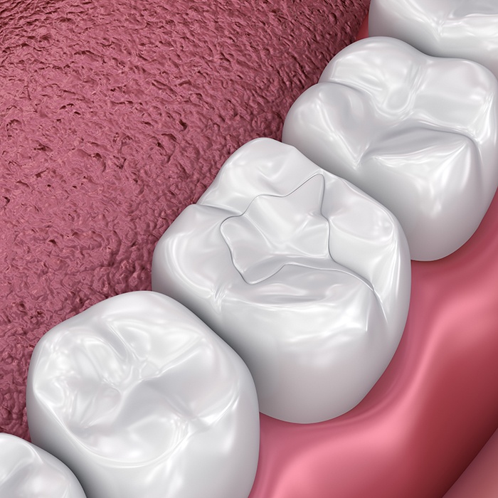 A 3D illustration of tooth-colored fillings