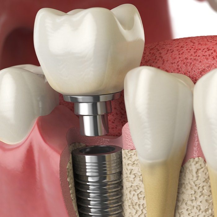 Closeup of dental implant post placed in jawbone