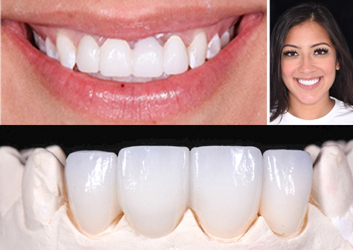 An up-close image of a woman’s teeth and her new veneers